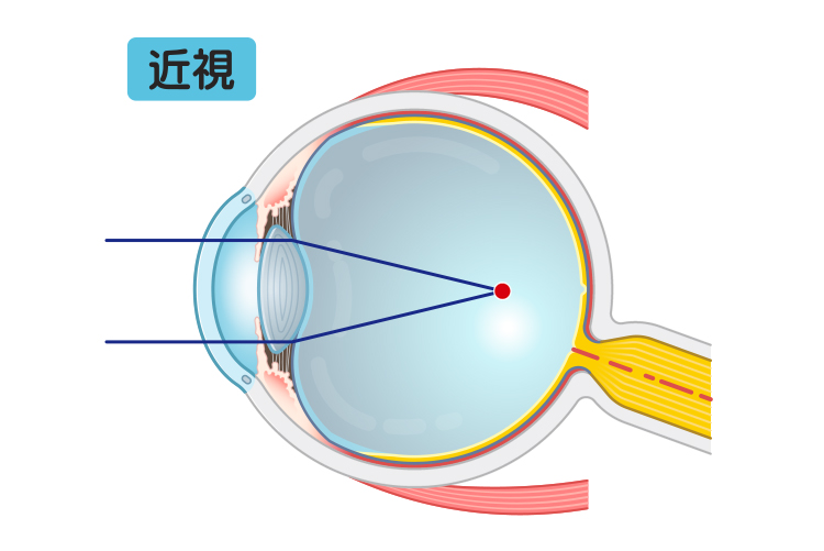 近視