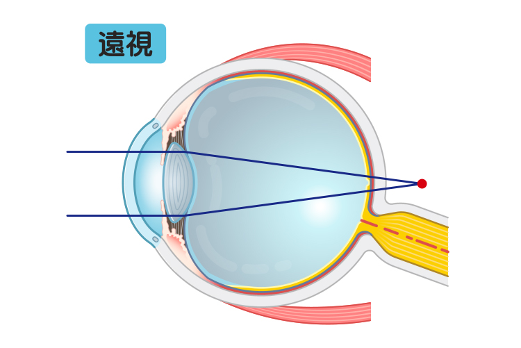 遠視