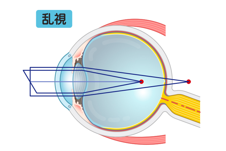 乱視